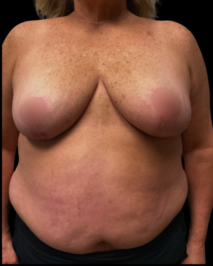Breast Reduction Before & After Patient #6391