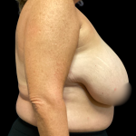 Breast Reduction Before & After Patient #6391