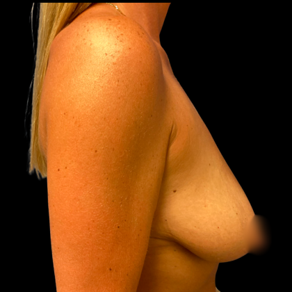 Mastopexy Augmentation Before & After Patient #6486