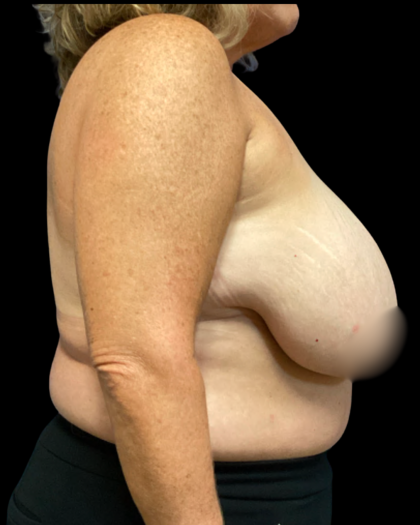 Breast Reduction Before & After Patient #6391