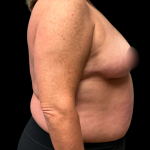 Breast Reduction Before & After Patient #6391