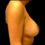 Mastopexy Augmentation Before & After Patient #6486