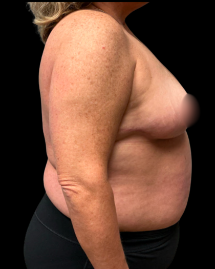 Breast Reduction Before & After Patient #6391