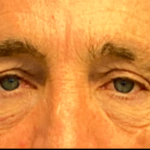 Blepharoplasty Before & After Patient #6487