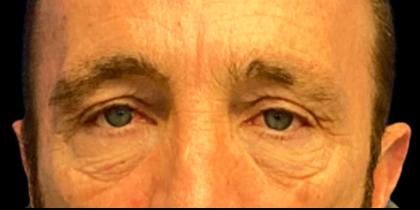 Blepharoplasty Before & After Patient #6487