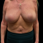 Breast Reduction Before & After Patient #6392