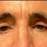 Blepharoplasty Before & After Patient #6487