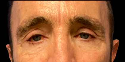 Blepharoplasty Before & After Patient #6487
