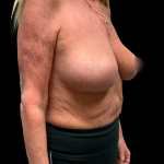 Breast Reduction Before & After Patient #6392