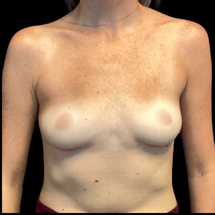Implant Removal Before & After Patient #6408