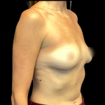 Implant Removal Before & After Patient #6408