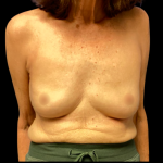 Implant Removal Before & After Patient #6409