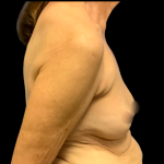 Implant Removal Before & After Patient #6409