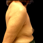 Implant Removal Before & After Patient #6409