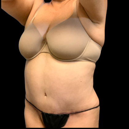 Tummy Tuck Before & After Patient #6411