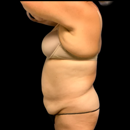 Tummy Tuck Before & After Patient #6411