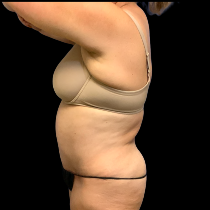 Tummy Tuck Before & After Patient #6411