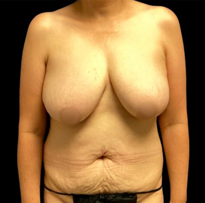 Circumferential Abdomen Before & After Patient #6555