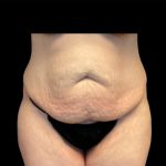 Circumferential Abdomen Before & After Patient #6556