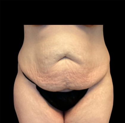 Circumferential Abdomen Before & After Patient #6556