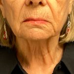 Facelift Before & After Patient #6557
