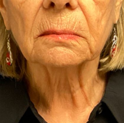 Facelift Before & After Patient #6557