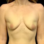 Mastopexy Augmentation Before & After Patient #6559