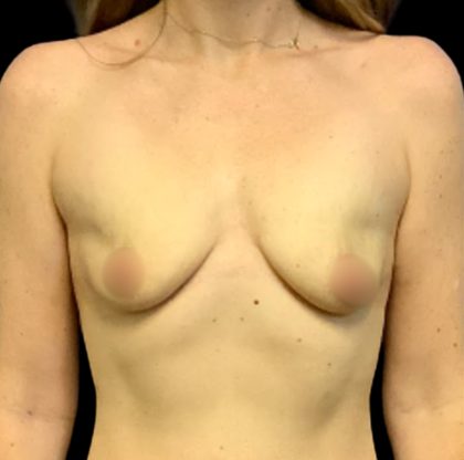Mastopexy Augmentation Before & After Patient #6559