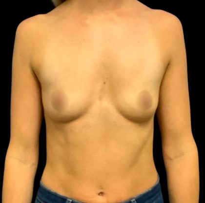 Mastopexy Augmentation Before & After Patient #6563