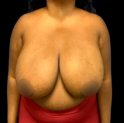 Breast Reduction Before & After Patient #6565