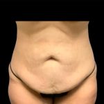 Tummy Tuck Before & After Patient #6567