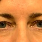 Blepharoplasty Before & After Patient #6569