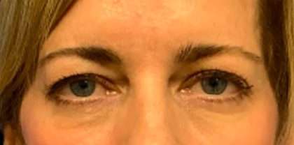 Blepharoplasty Before & After Patient #6569