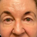 Blepharoplasty Before & After Patient #6570