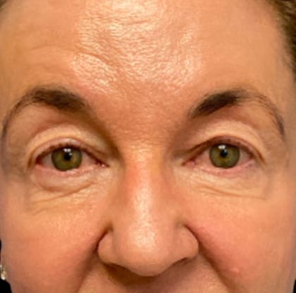 Blepharoplasty Before & After Patient #6570