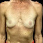 Breast Augmentation Before & After Patient #6572