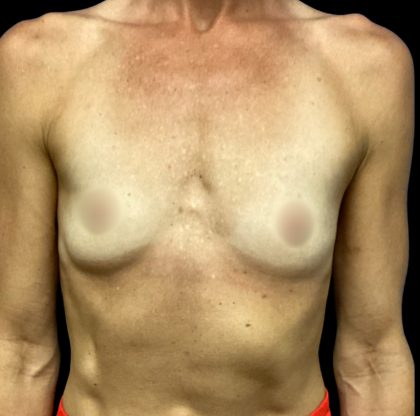 Breast Augmentation Before & After Patient #6572