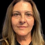 Facelift Before & After Patient #6573