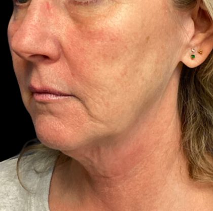 Facelift Before & After Patient #6574