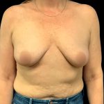 Breast Augmentation Before & After Patient #6548