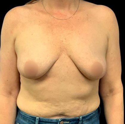 Breast Augmentation Before & After Patient #6548