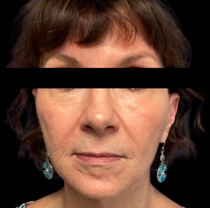 Facelift Before & After Patient #6575