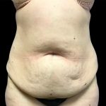 Liposuction Before & After Patient #6577