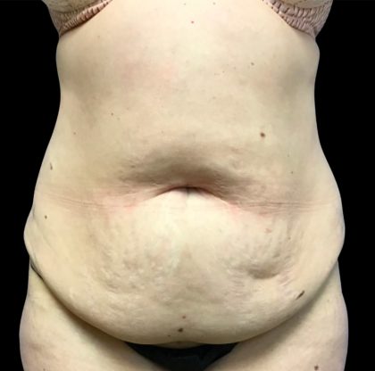 Liposuction Before & After Patient #6577