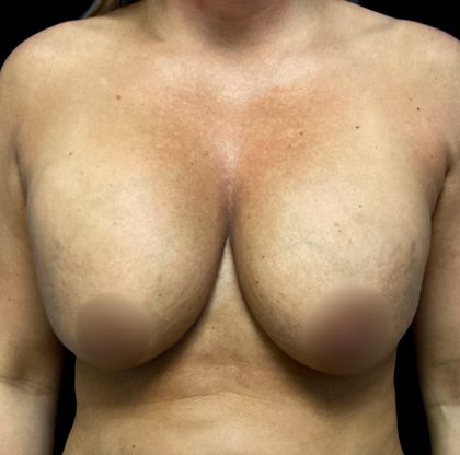 Implant Removal Before & After Patient #6578
