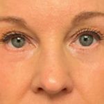 Blepharoplasty Before & After Patient #6579