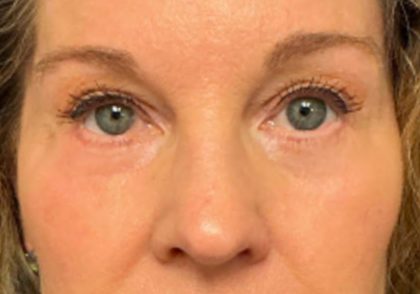 Blepharoplasty Before & After Patient #6579