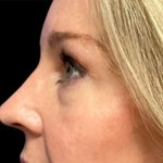 Blepharoplasty Before & After Patient #6580