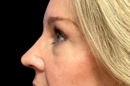 Blepharoplasty Before & After Patient #6580