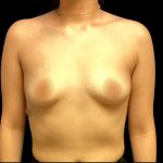 Breast Augmentation Before & After Patient #6549